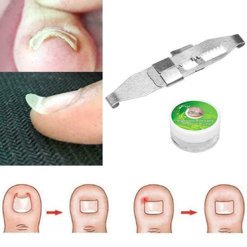 Ingrown Toe Nail Correction Pedicure Straightener Clippers Recover B3M0