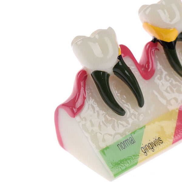 Dental Lab Periodontal Disease Assort Tooth Typodont Study Teaching Teeth ModFT