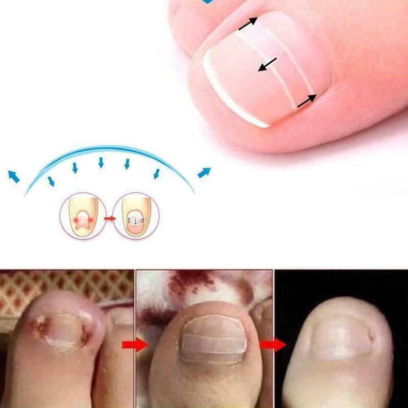 10Pcs Ingrown Toenail Straightening Clip Curved Brace Glue With Kit Correct F2V4