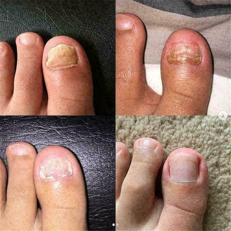 Nail Treatment Essential Oil Nail Nourishing Brightening Promote Nails Foot Y2J3