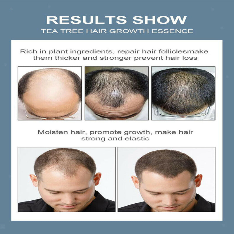 20ml Tea Tree Essential Oil For Hair Growth Lice Face Prevent