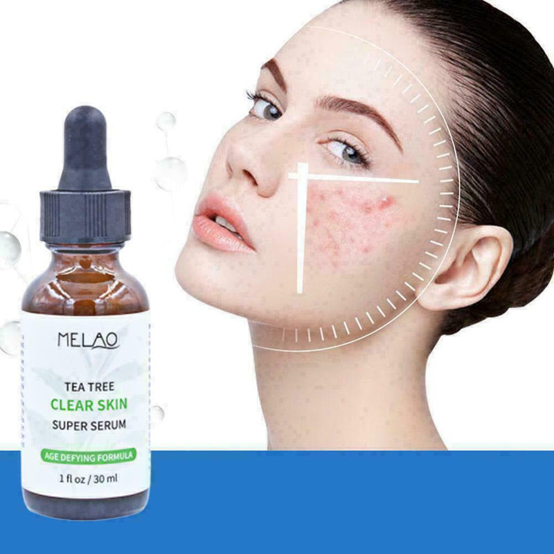Pure Natural Tree Essential Oil Acne Treatment Face Care Z Skin H4F4 H2F6