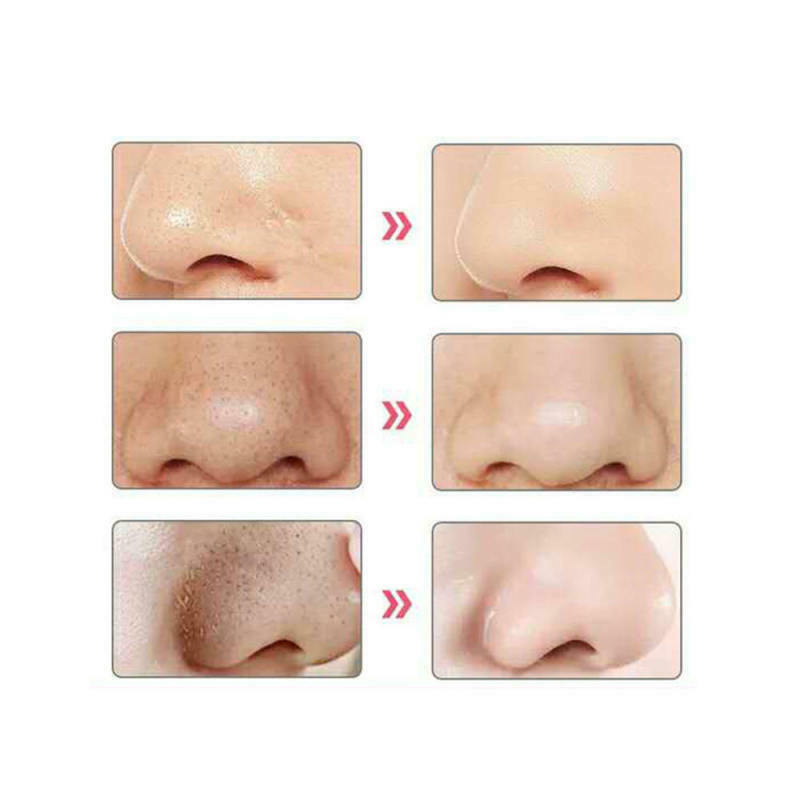 1PC Electric Blackhead Instrument Acne Cleansing Face Pore Nose Cleaner Ar ZBI