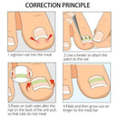 10Pcs Ingrown Toenail Straightening Clip Curved Brace Glue With Kit Correct F2V4