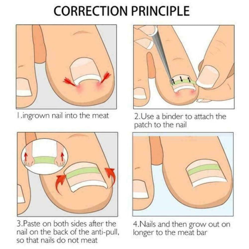 10Pcs Ingrown Toenail Straightening Clip Curved Brace Glue With Kit Correct F2V4