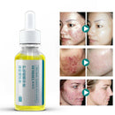 Hemeiel Shrink Pores Serum Acne Treatment Liquid Moisturizing Face Serum An T8W9