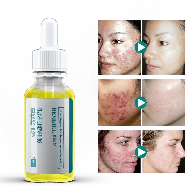 Hemeiel Shrink Pores Serum Acne Treatment Liquid Moisturizing Face Serum An T8W9