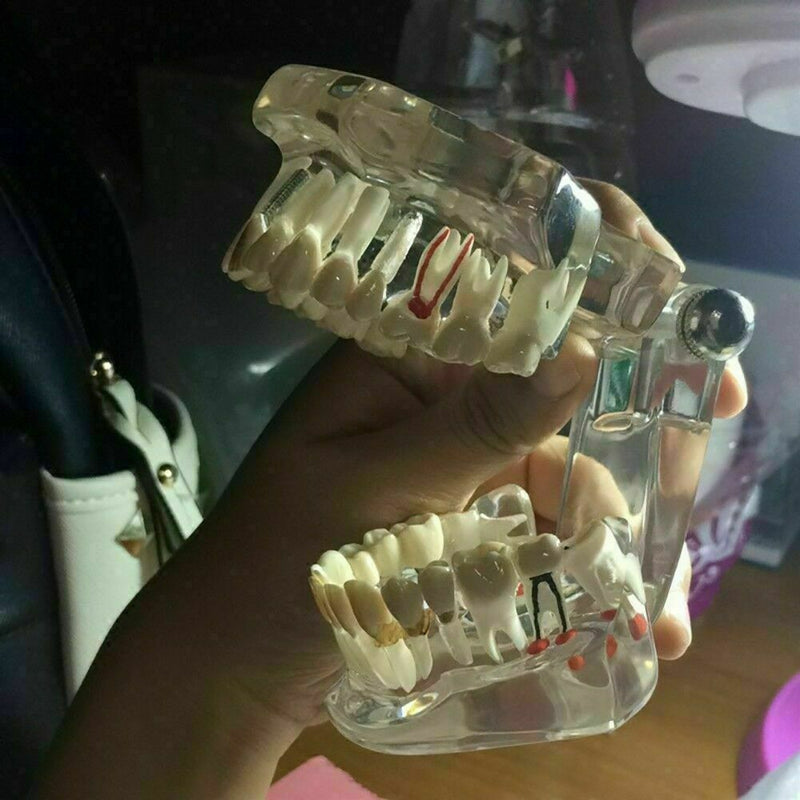 Teeth Restoration Implant Removable Disease Tooth & Teaching Dental Bridge A2X0