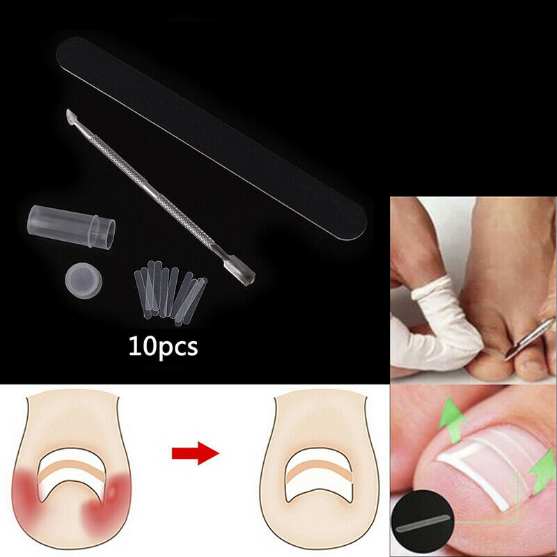 Ingrown Toe Nail Correction Kit Toenail Treatment Nail Pusher Recover Foot C Pg