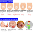 12pcs toenail correction tool ingrown wire fixer toe nail recover foot M&E