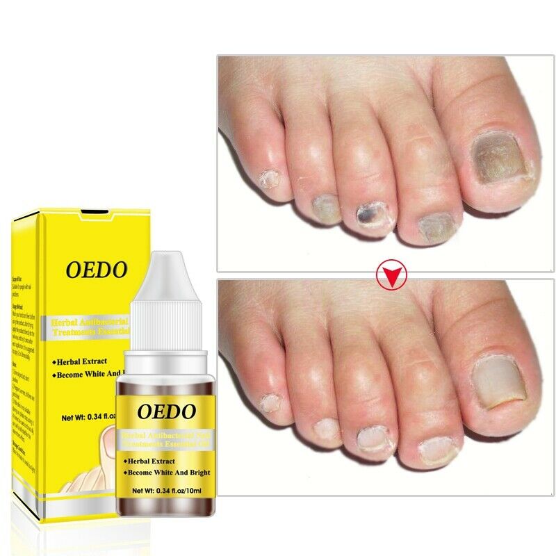 Oedo herbal Antibacterial Nail Treatments Essential Oil Herbal Extract Nail A4R7