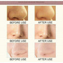 Blackhead Remover Skin Care Pore Vacuum Acne Pimple Clea Face Tool New Remo B0T7