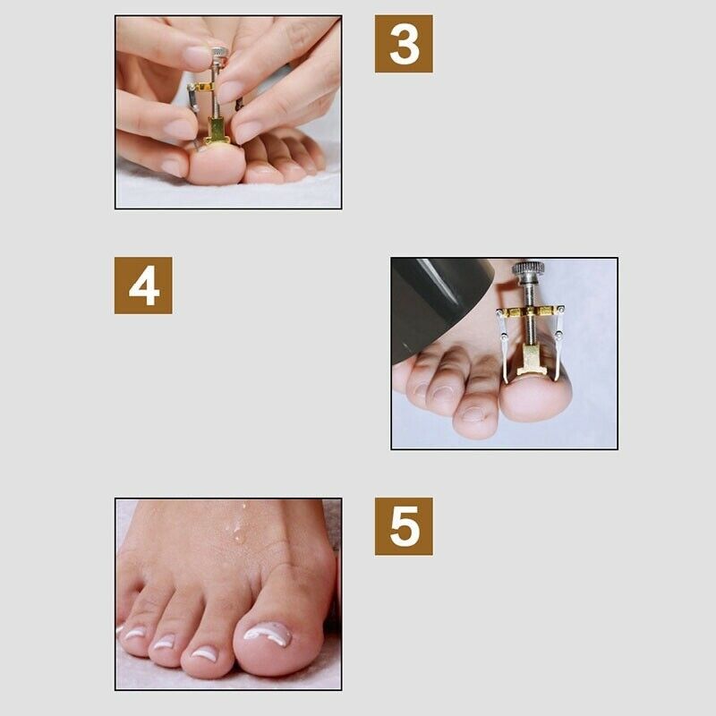 Pro Ingrown Toe Nail Recover Toenail Correction Pedicure Fixer Straighten DWY