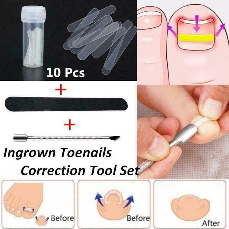 10Pcs Ingrown Toenail Straightening Clip Curved Brace Glue With Kit Correct F2V4