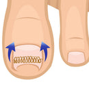 6Xingrown Toenail Correction Wire Fixer Pedicure Recover Corrector Foot Care OZ