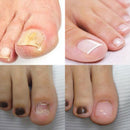 Firstsun Nail Pen Nutrient Solution Removes Onychomycton Nail Repair Liquid Z4O8