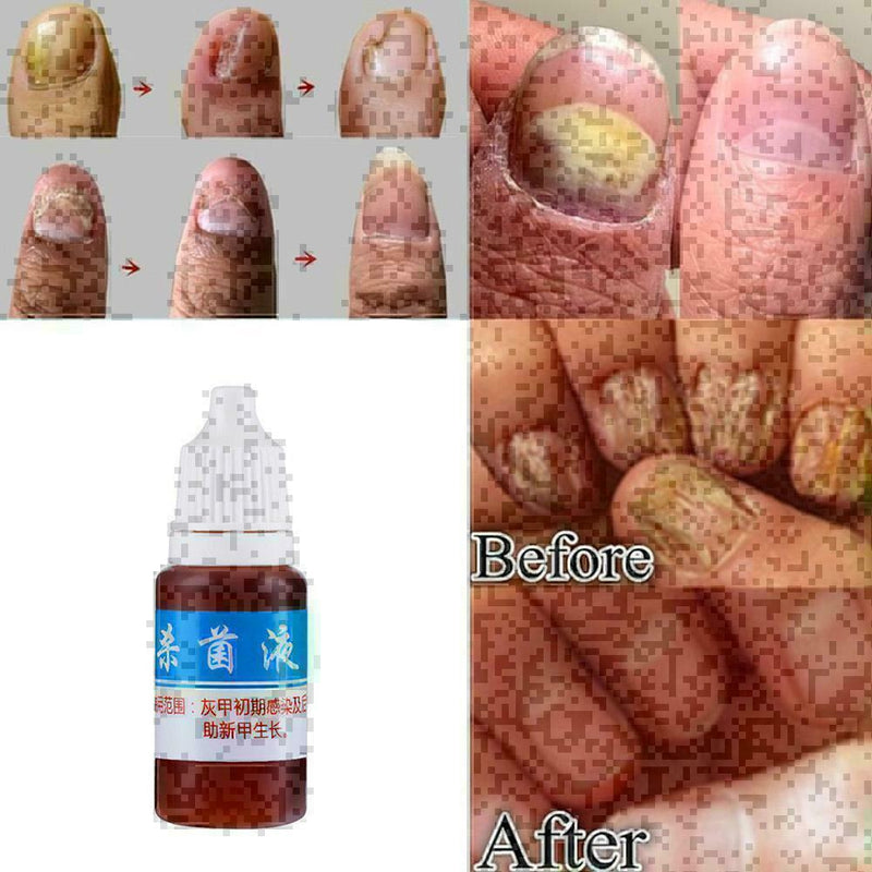 10ml Nail Repair Treatment Liquid Cleanser Onychomycosis Disinfect Water ne U6U7