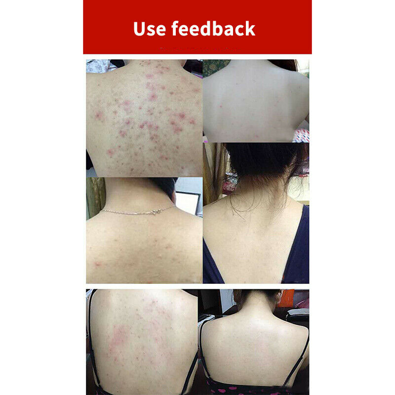 100G Sea Salt Soap Cleaner Removal Pimple Pores Acne Treatment Goat Milk Mo C4N4