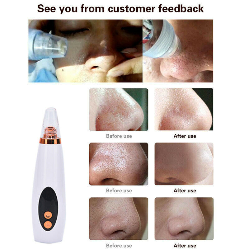Blackhead Pimple Remover Face Pore Skin Care Acne Pore Cleaner Facial Tools