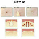 Pack of 36Pcs Invisible Acne Patch Anti Pimple Stickers Spot Scar Care Treatment