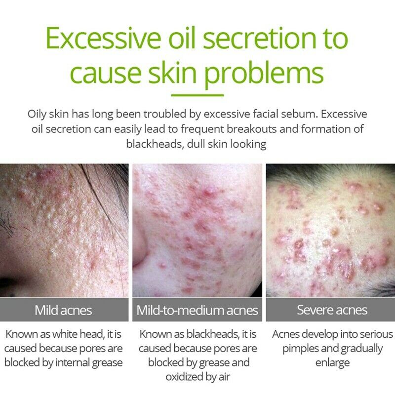 Vibrant Glamour Tea Tree Repair Face Serum Acne Scar Shrink Pores Face Seru I6N4