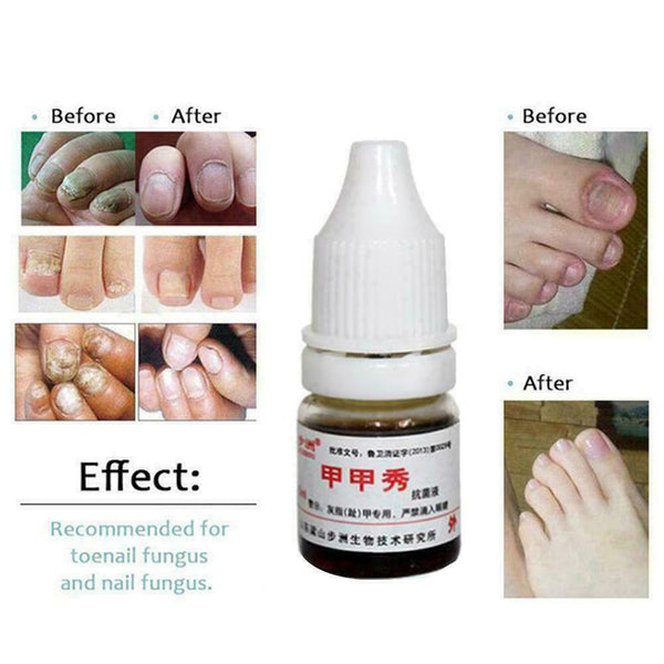 Footcare Oil 15ml Gehwol Nail Softner Fluid Ingrown Nails Callus Toe Z2L1