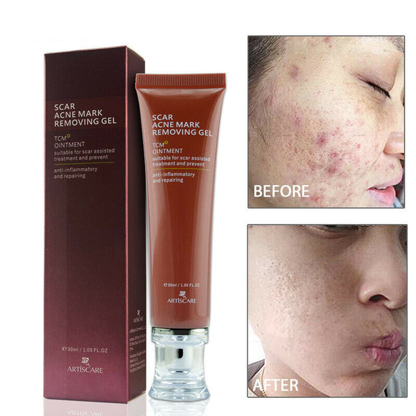 Artiscare Scar Acne Mark Removing Gel Tcm Blackhead Treatment Whitening Ski R7L9