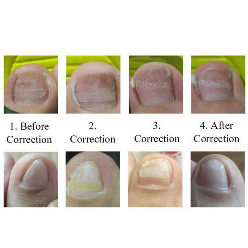 10Pcs Ingrown Onyxis Toe Nail Correction Recover Pedicure Orthotic Tool