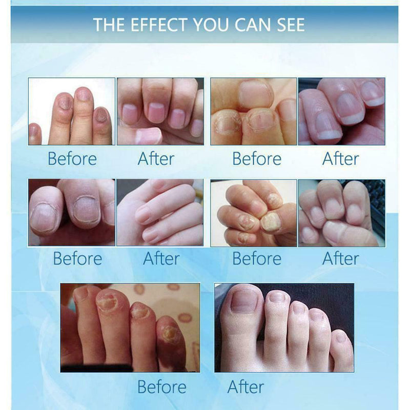 Removal Onychomycosis Toe Fungus Nail Repair Anti Fungal Treatment Liquid N H0E7