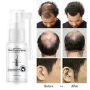 Anti Hair Loss Hair Growth Spray Essential Liquid Dry Regeneration Repair H G7A3