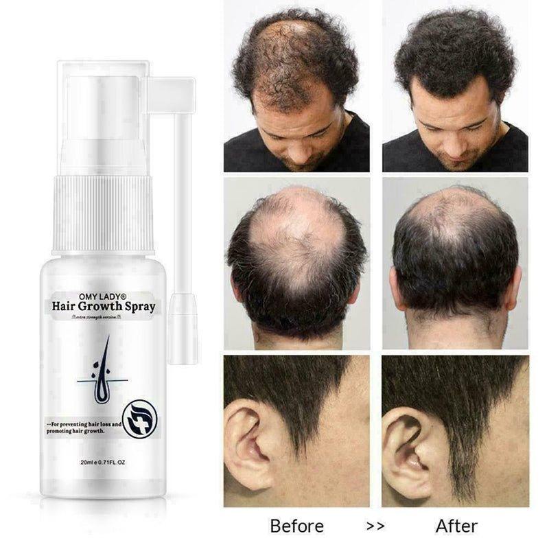 Anti Hair Loss Hair Growth Spray Essential Liquid Dry Regeneration Repair H G7A3