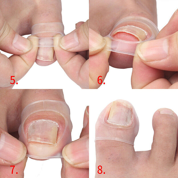 Silicone Ingrown Toenail Correction Tool Invisible Ingrown Toe Nail Treatmen Cy