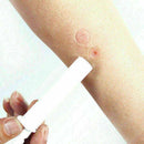 Mosquito Bites Extraction Itching Instant Bug Relief Bite Extraction Vacuum